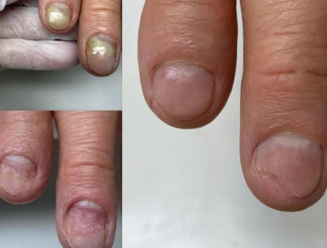 Podonails