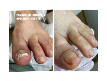 Podonails