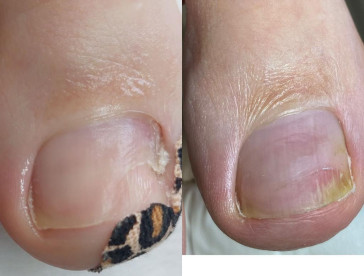 Podonails