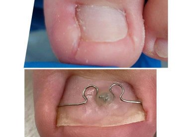 Podonails