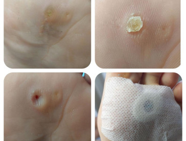 Podonails