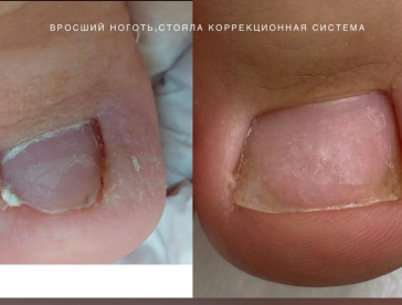 Podonails